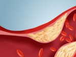 Cảnh báo 6 bệnh lý dễ gặp phải nếu cholesterol tăng cao
